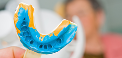 dental implants